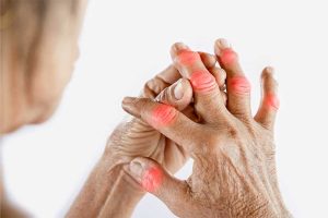 Arthritis and how superfood can heal it